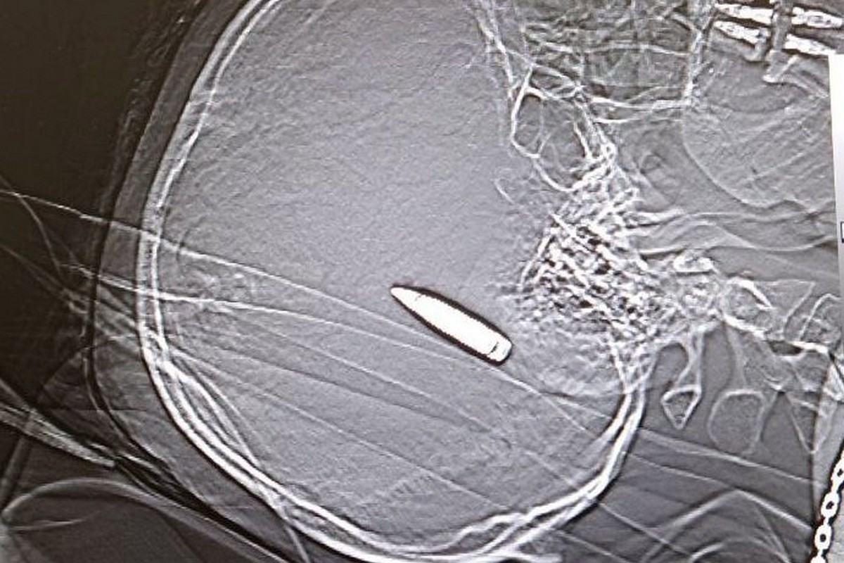 У лікарні Дніпра рятують 35-річного пацієнта з кулею посередині мозку