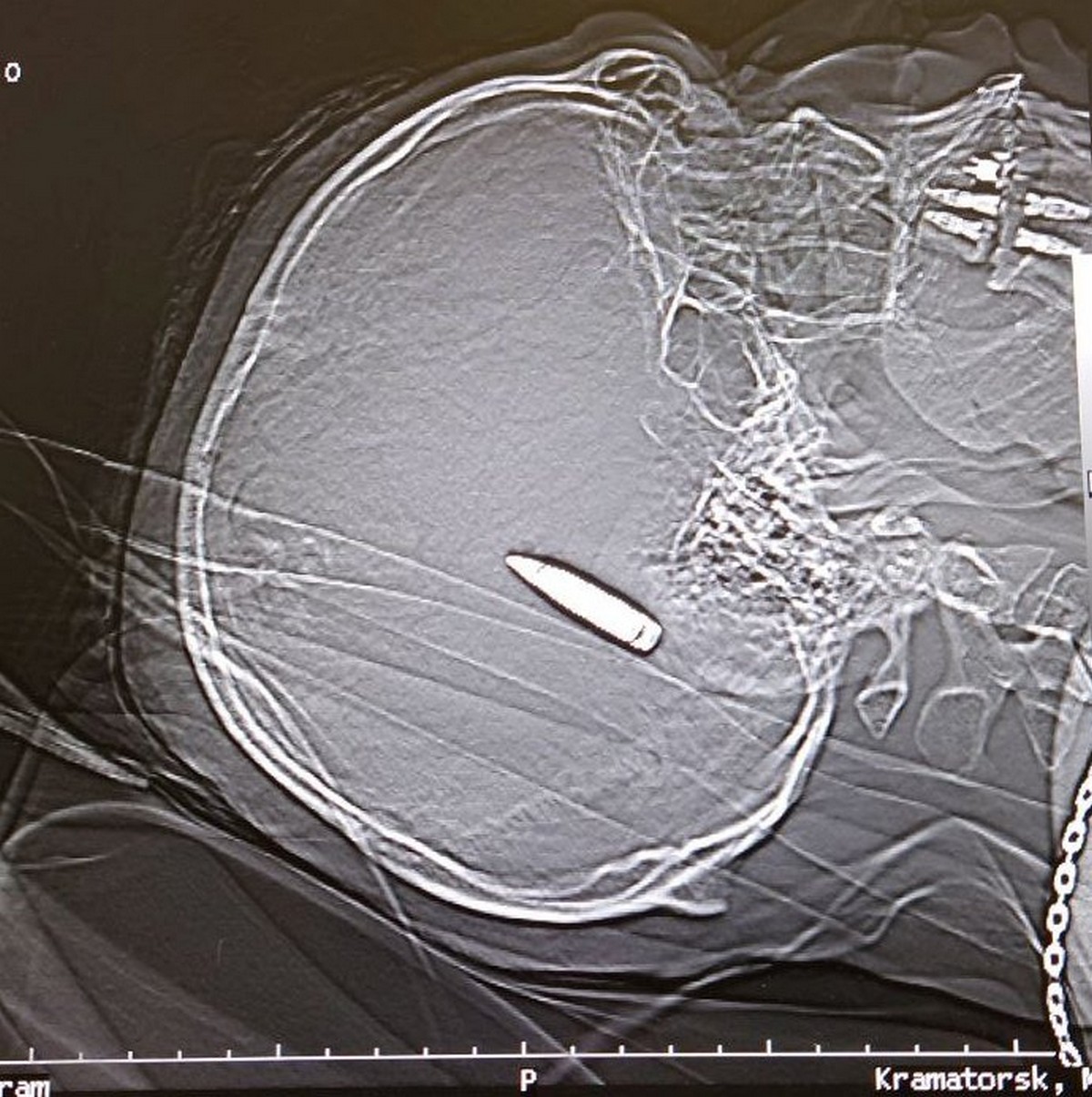 У лікарні Дніпра рятують 35-річного пацієнта з кулею посередині мозку