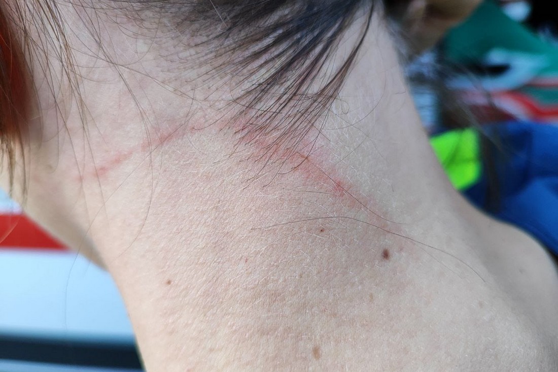Душила фонендоскопом і роздерла шию: на Дніпропетровщині п’яна жінка напала на медиків швидкої