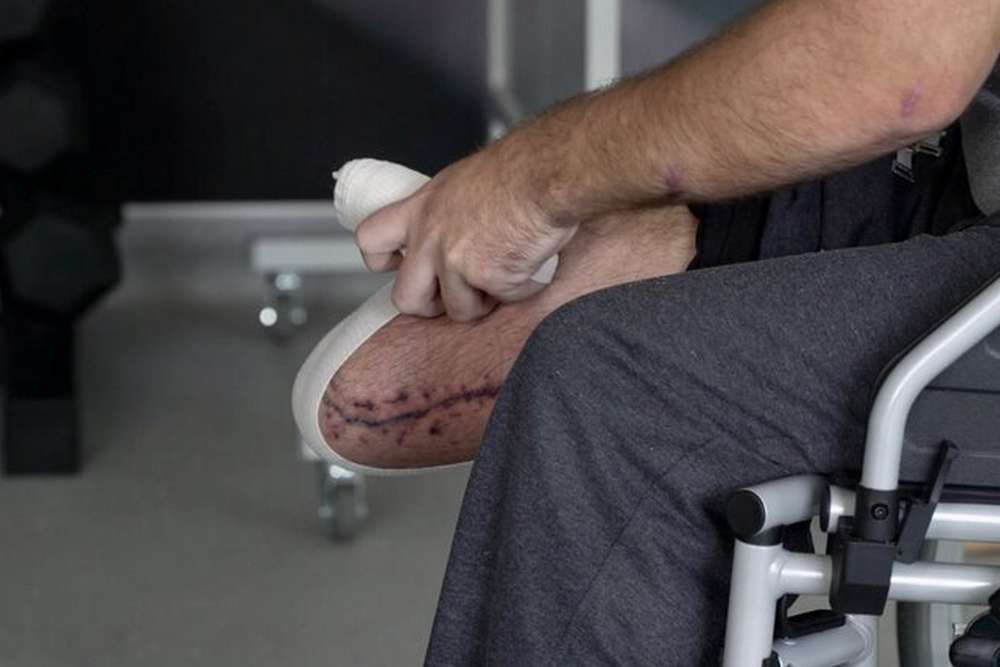 Захисник з Нікополя, який втратив ногу на фронті: «Думаю, я в армії ще знадоблюсь»