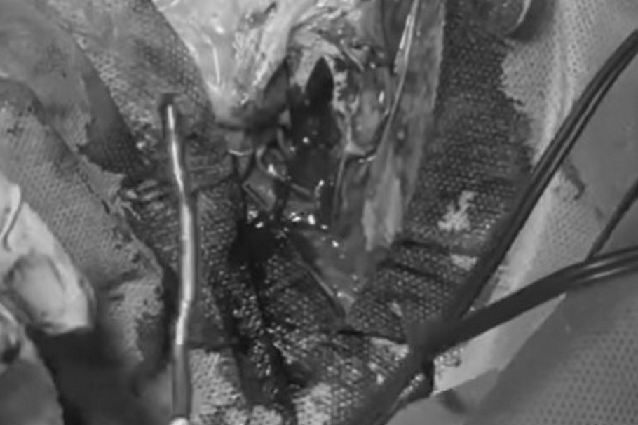 У лікарні Дніпра з голови пораненого воїна дістали відламок довжиною 10 см (відео) 1 У лікарні Дніпра з голови пораненого воїна дістали відламок довжиною до 10 см (відео)