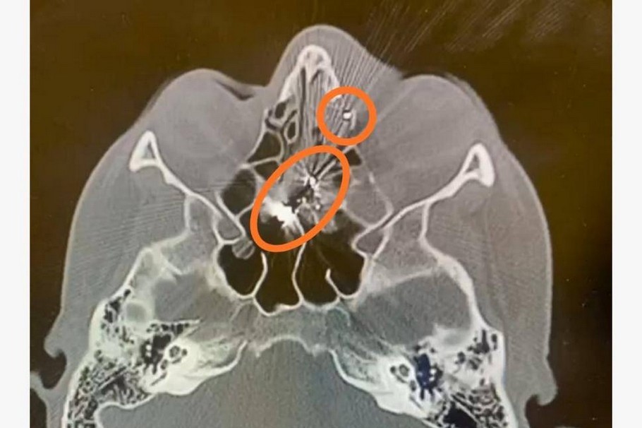 На Дніпропетровщині жінка чистила зброю і вистрілила собі в око 1 На Дніпропетровщині жінка чистила зброю і вистрілила собі в око