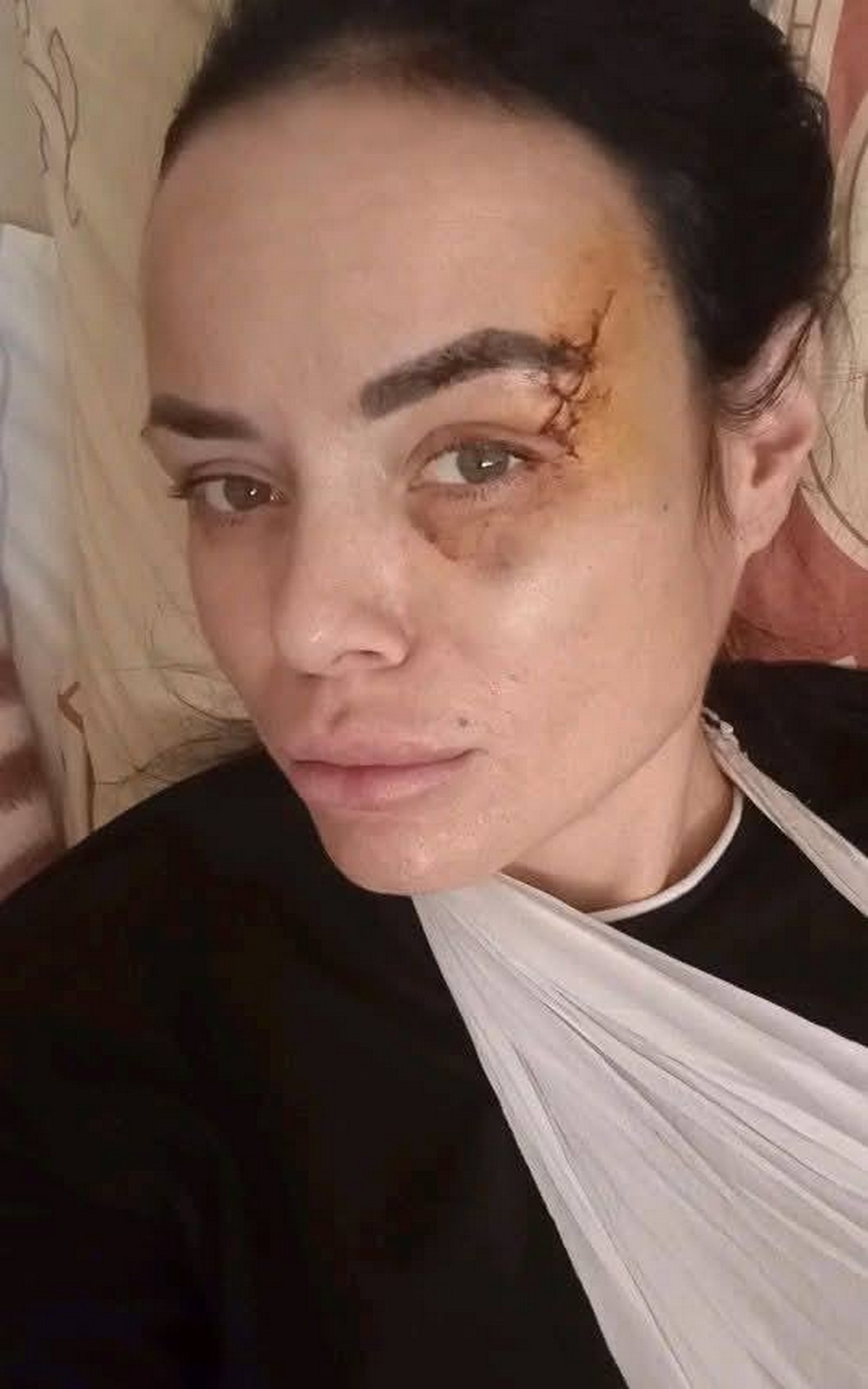 Захисниця з Покрова отримала важкі поранення внаслідок удару ворожого дрону: потрібна допомога