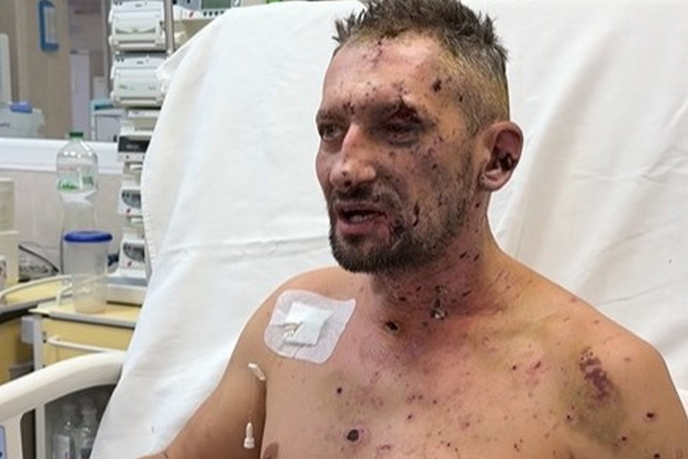 Поранення було мало сумісне з життям: у Дніпрі рятують журналіста, який єдиний вижив під час удару по знімальній групі Freedom у Краматорську 1 Обгоріле обличчя було схоже на мумію: у Дніпрі рятують журналіста, який єдиний вижив під час удару по знімальній групі Freedom у Краматорську