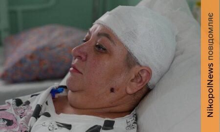«Знімала білизну під вікном, аж тут дрон вдарив по голові» - поранена у Нікополі жінка розповіла про страшний день у своєму житті